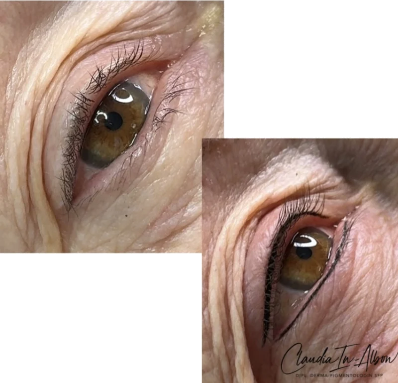 Augen vorher und nachher